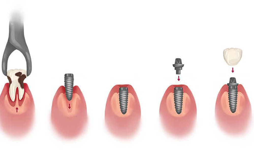 راهنمای انتخاب کلینیک ایمپلنت برای ساکنان تهران‌پارس