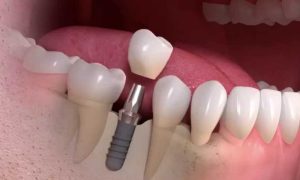 ایمپلنت دندان دو فک در تهران؛ هزینه، زمان درمان و مراقبتها