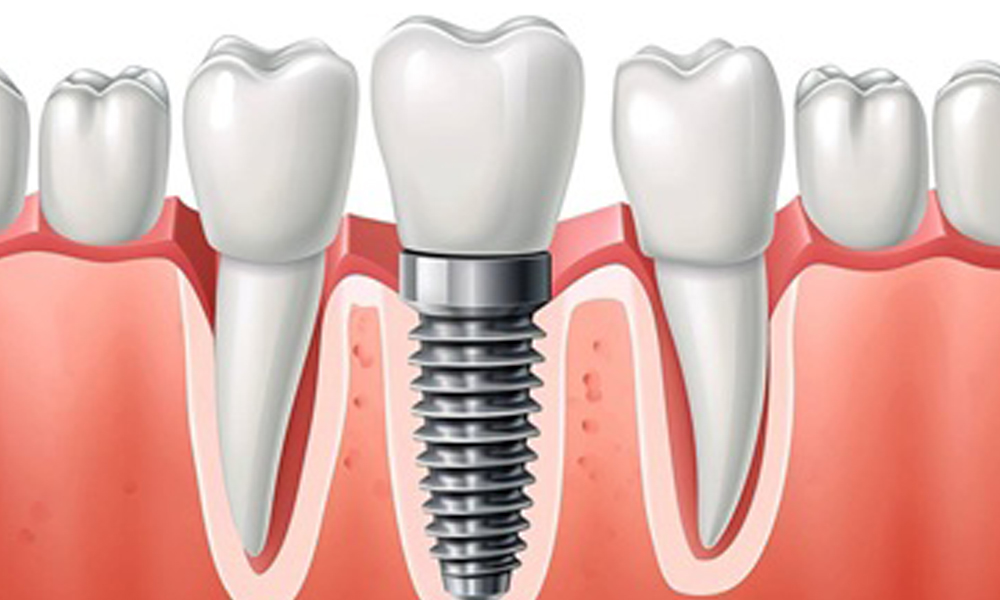 ایمپلنت دندان دو فک در تهران؛ هزینه، زمان درمان و مراقبت‌ها