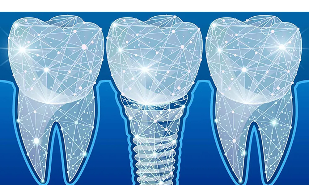 ایمپلنت دندان دو فک در تهران؛ هزینه، زمان درمان و مراقبت‌ها