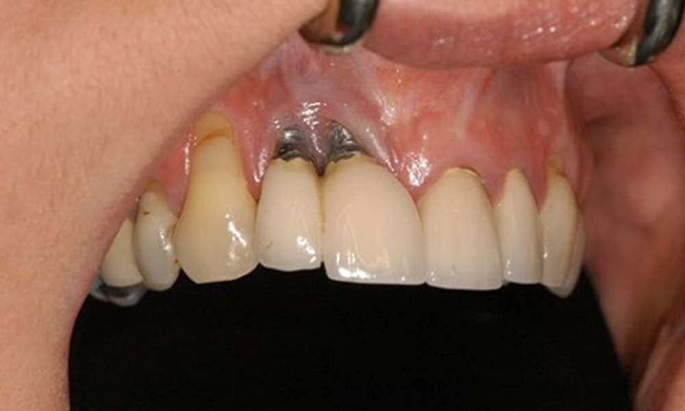 عوارض ایمپلنت دندان و نحوه پیشگیری در تهران