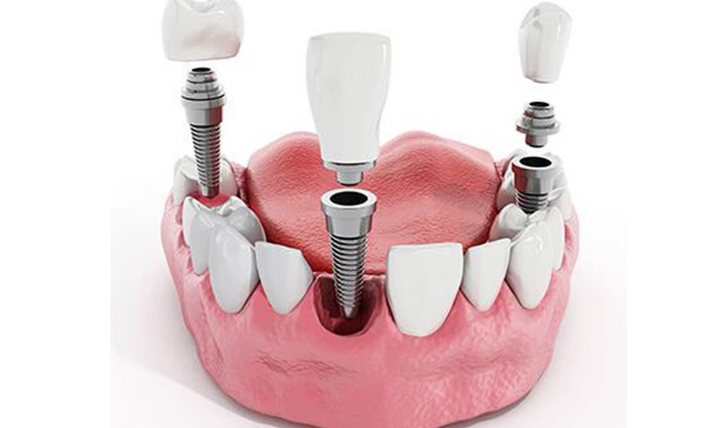 چرا ایمپلنت دندان در تهران گران‌تر است؟ بررسی هزینه‌های جانبی
