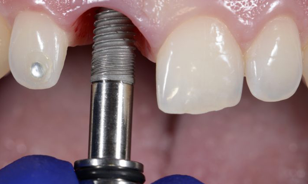 انتخاب کلینیک ایمپلنت زعفرانیه