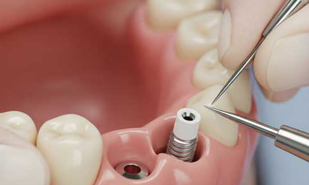 راهنمای انتخاب کلینیک ایمپلنت برای ساکنان زعفرانیه