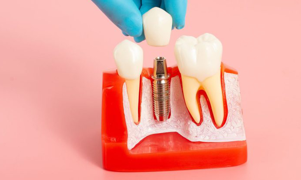 راهنمای انتخاب کلینیک ایمپلنت برای ساکنان زعفرانیه