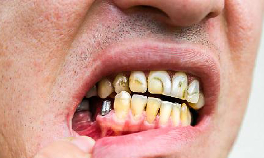 عوارض ایمپلنت دندان و نحوه پیشگیری در تهران