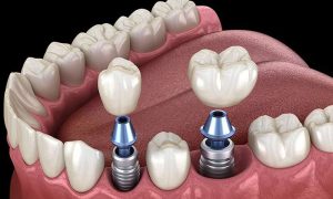 ایمپلنت دندان با بیمه