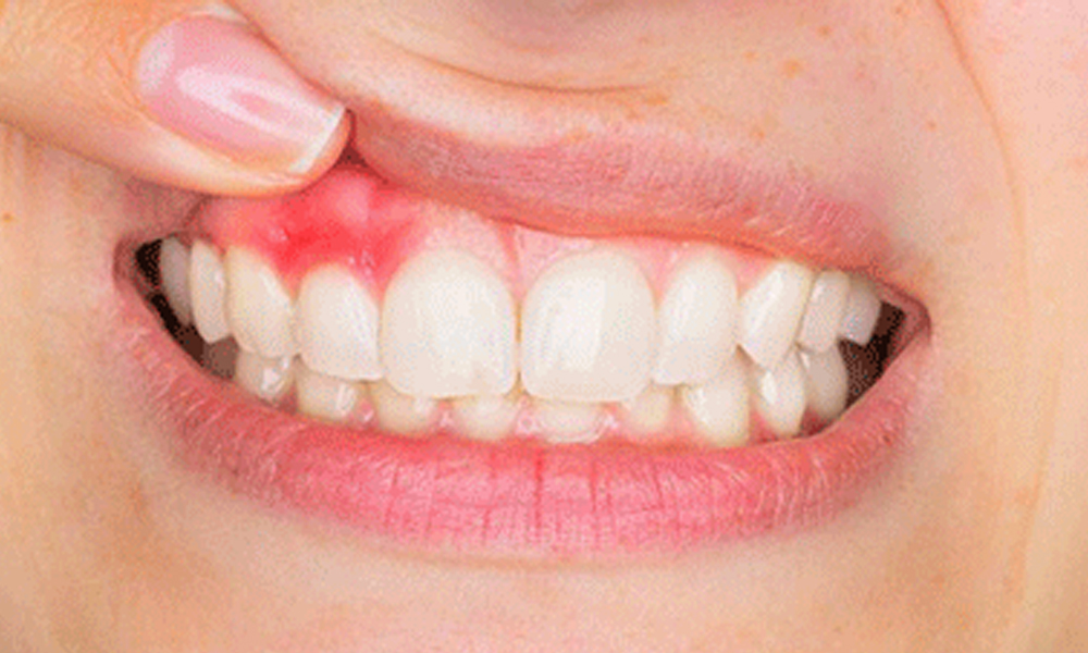 عوارض ایمپلنت دندان و نحوه پیشگیری در تهران