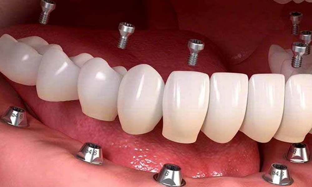 کاشت ایمپلنت در مناطق مختلف تهران؛ شرق، غرب، شمال و جنوب