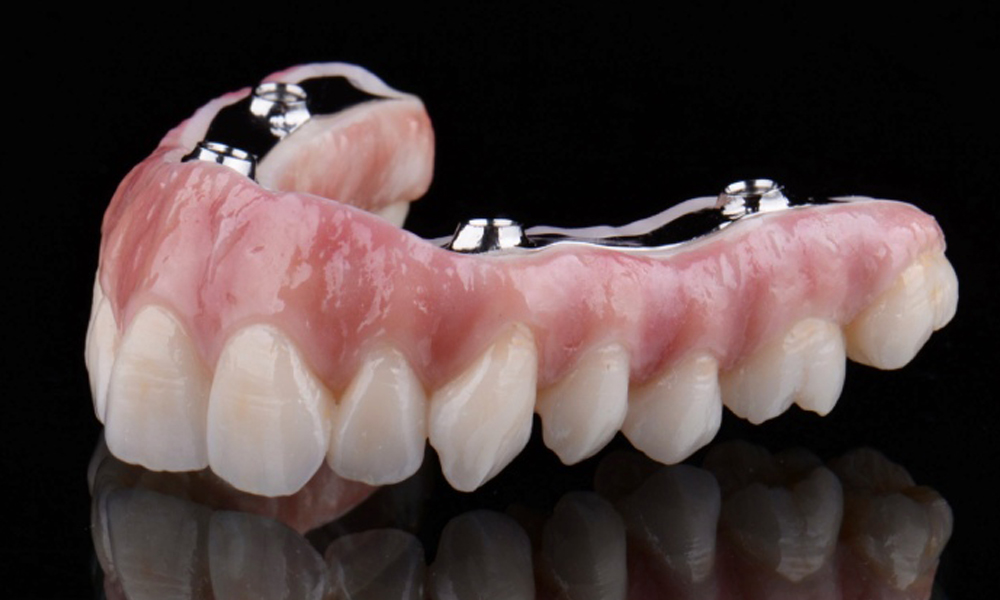 کاشت ایمپلنت در مناطق مختلف تهران؛ شرق، غرب، شمال و جنوب