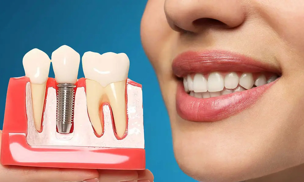 کاشت ایمپلنت در مناطق مختلف تهران؛ شرق، غرب، شمال و جنوب