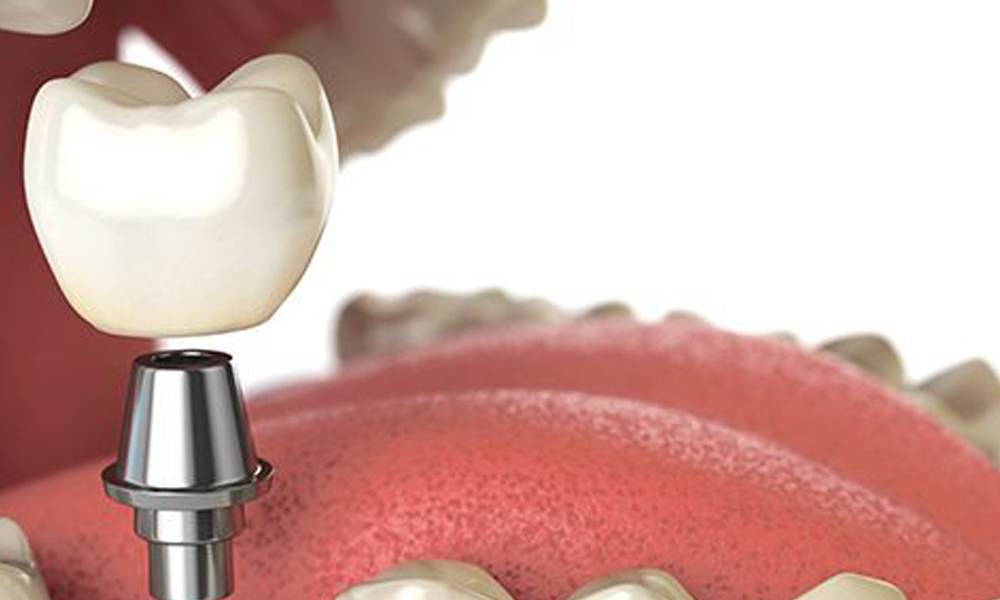 کاشت ایمپلنت در مناطق مختلف تهران؛ شرق، غرب، شمال و جنوب