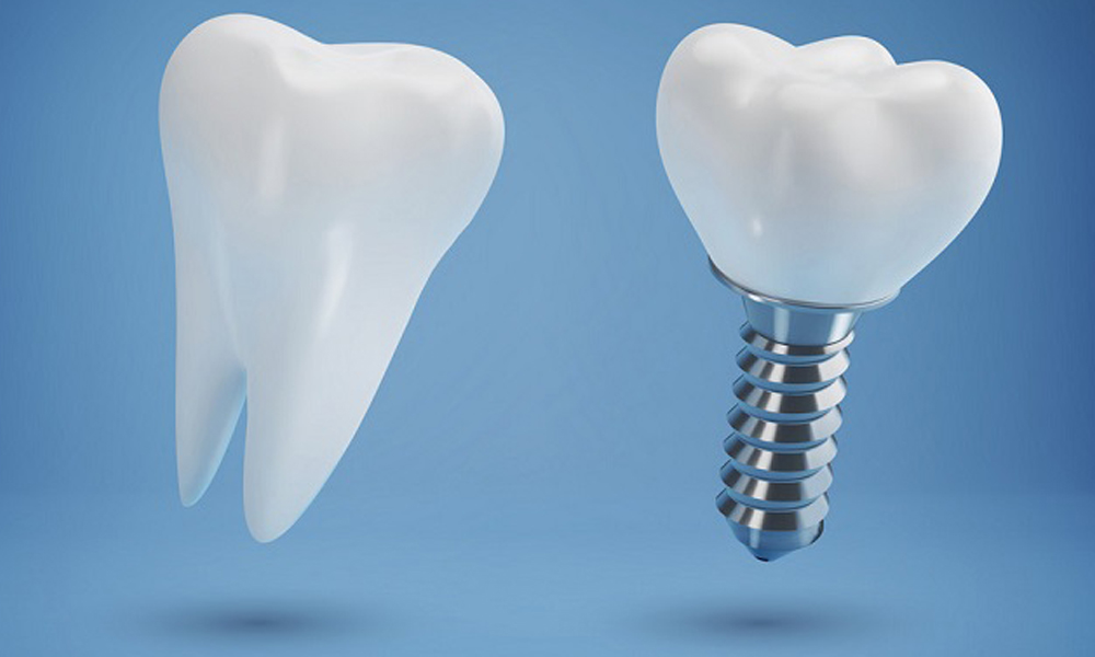 مشاوره ایمپلنت رایگان در تهران