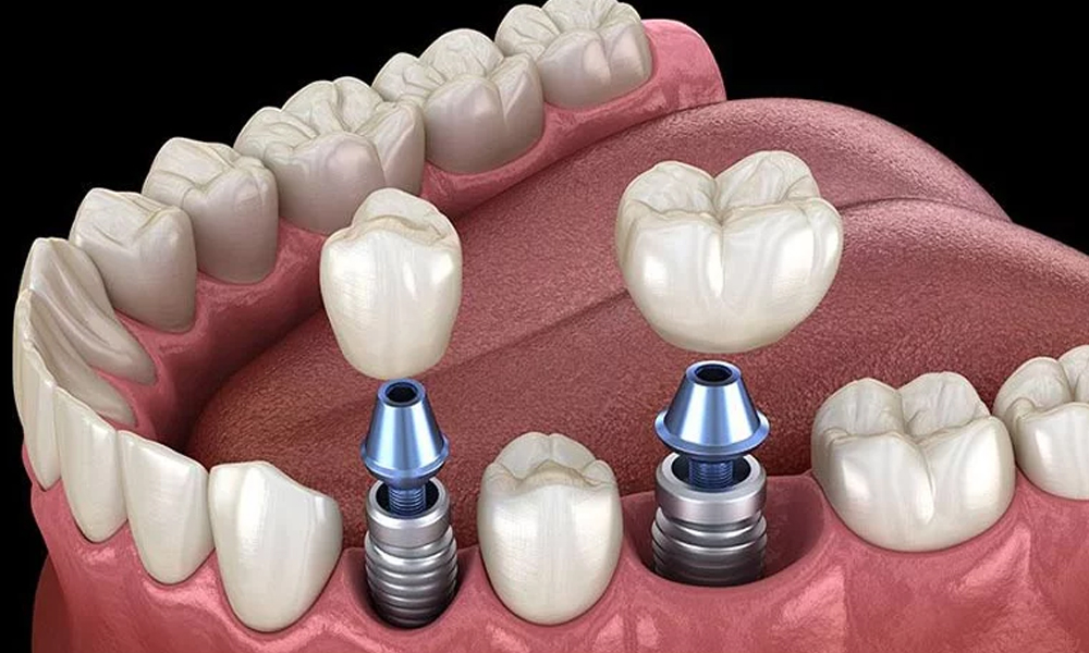 ایمپلنت دندان با بیمه
