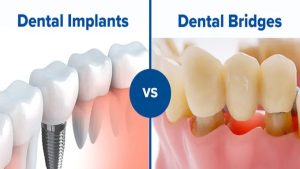 ایمپلنت دندان