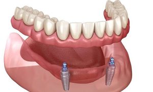 ایمپلنت مینی (Mini Implant): کاربردها، مزایا و محدودیت‌ها