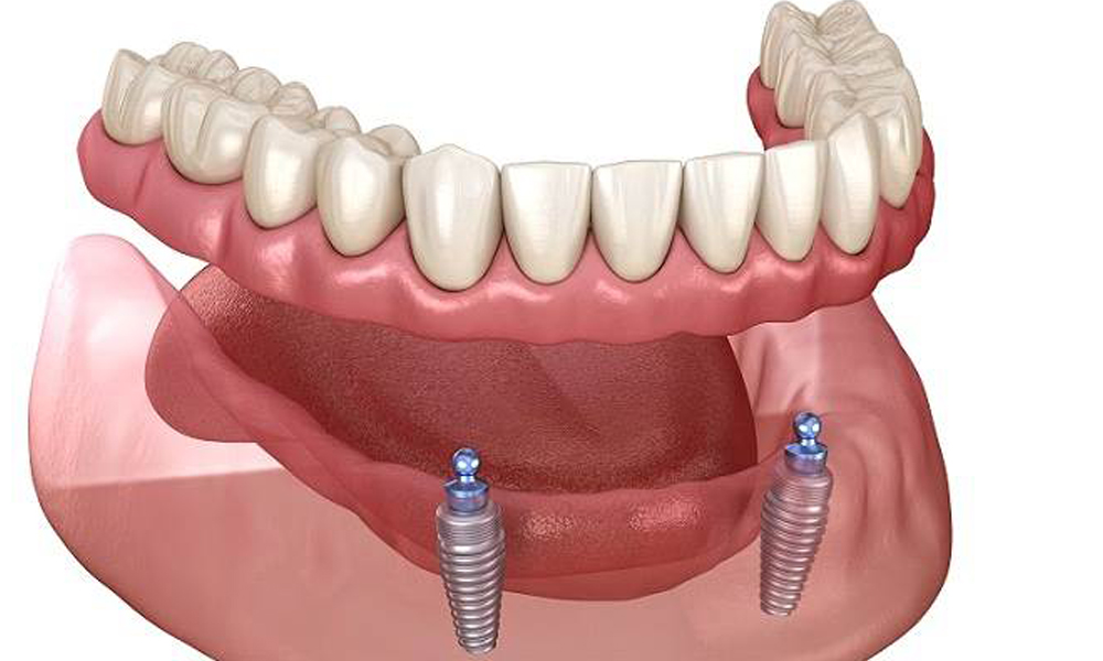 ایمپلنت مینی (Mini Implant): کاربردها، مزایا و محدودیت‌ها