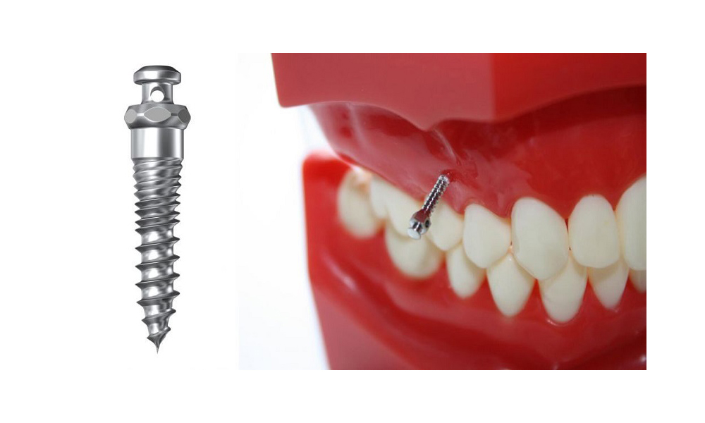 ایمپلنت مینی (Mini Implant): کاربردها، مزایا و محدودیت‌ها