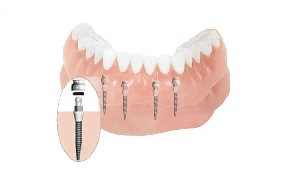 ایمپلنت مینی (Mini Implant): کاربردها، مزایا و محدودیت‌ها