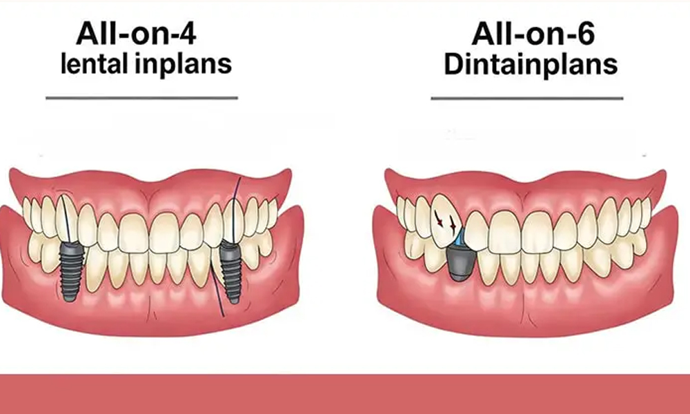 ایمپلنت تمام فک در یک روز: ممکن است؟ بررسی پروتکل All-on-4 و All-on-6