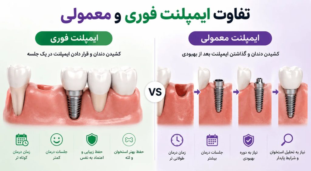 فرق ایمپلنت معمولی با ایمپلنت فوری
