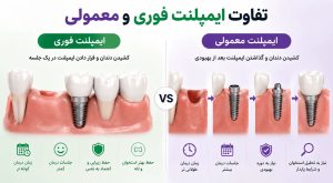 فرق ایمپلنت معمولی با ایمپلنت فوری